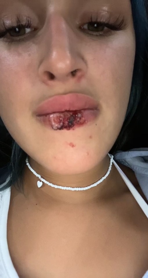 Ellie’s bottom lip burned so badly it was blistered, bleeding and cracked. She is pictured when she got home from the holiday