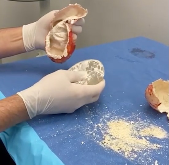 The footage shows an old breast implant being pulled from what viewers described as a "kinder egg" shell