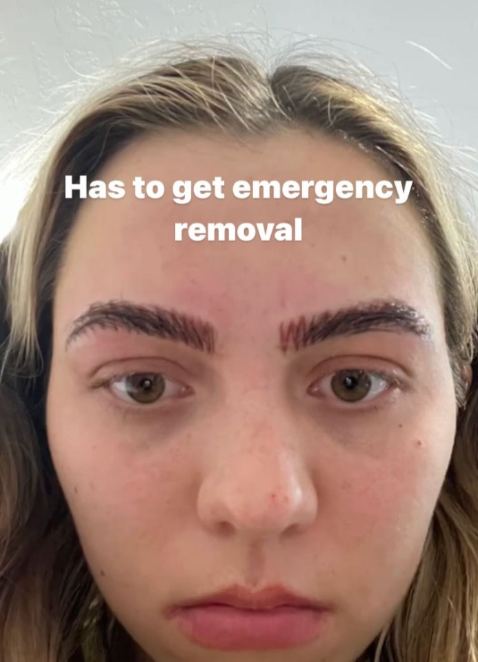 Isabelle hated the results so much, she arranged a removal appointment shortly after getting them microbladed