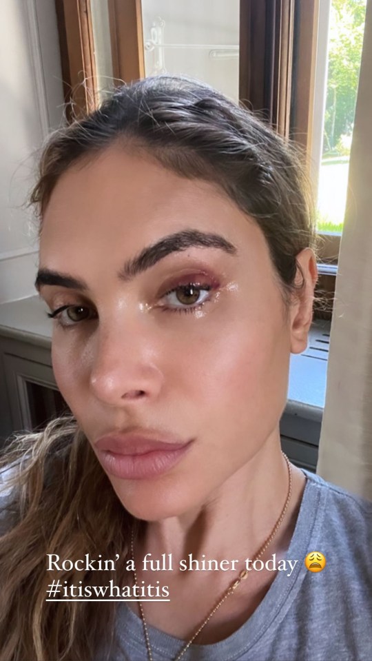 Ayda Field showed off her black eye after a surgical procedure