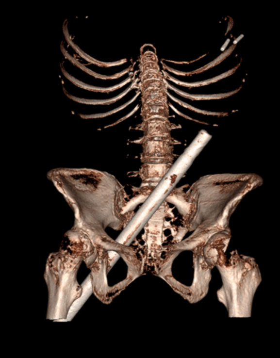 X-rays show a woman's pelvis after she fell from a stepladder onto a fake Christmas tree, causing the stem - a metal pole - to impale her