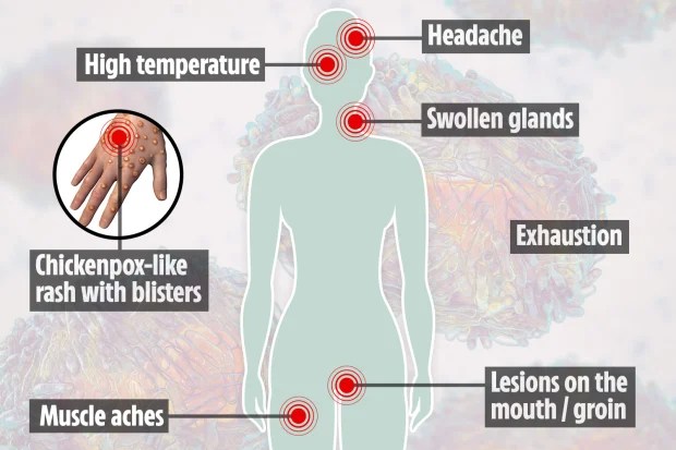 The symptoms of monkeypox