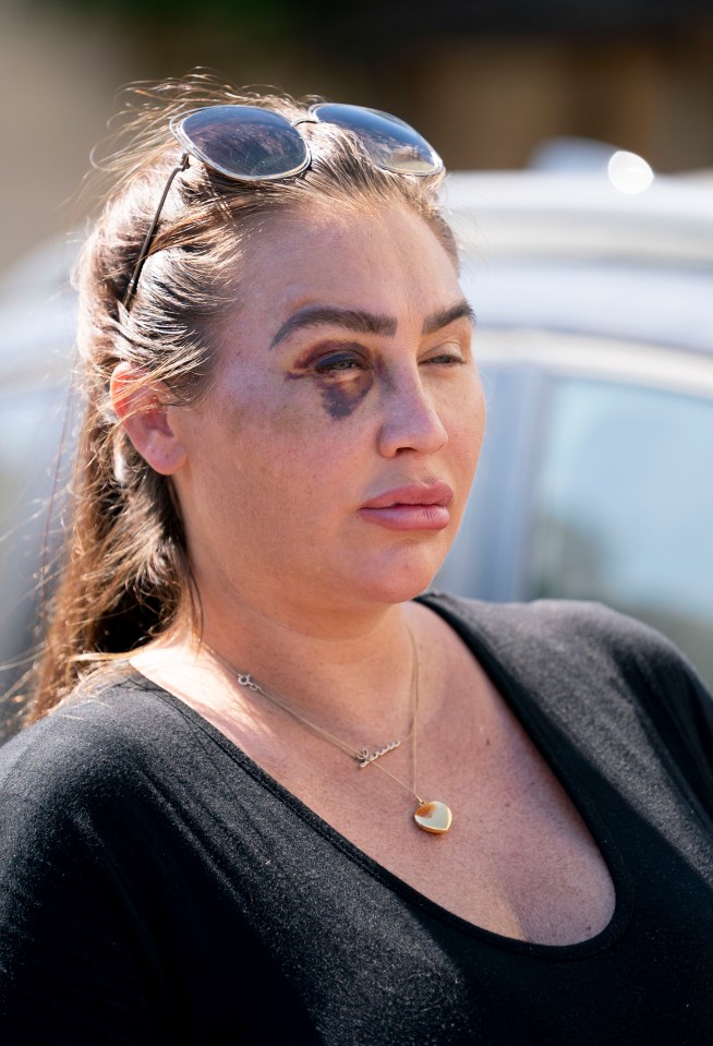 Lauren pictured with a black eye