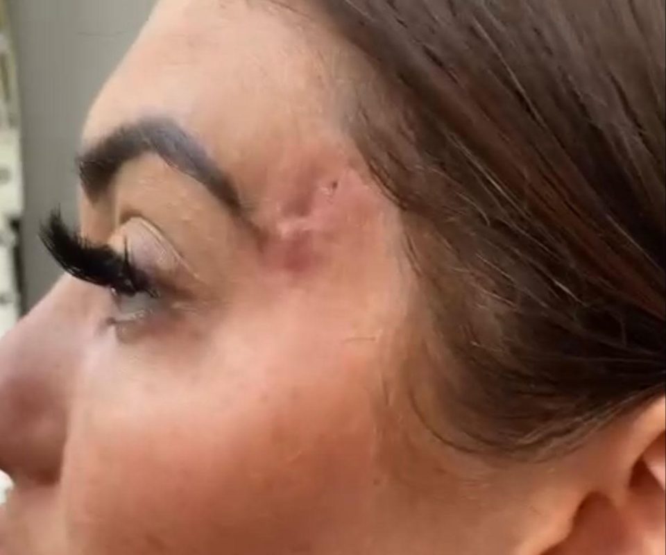 The star was hospitalised after suffering a botched 'fox' eye lift and now she says she needs a skin graft to fix the dent in her face