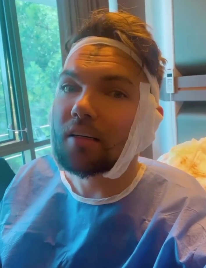 Sam Gowland showed off his painfully swollen face after a beard transplant