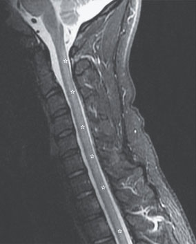 Scans revealed abnormal brightness around the spinal cord  (pictured left) which is indicative of myelopathy: pressure on the spinal cord (pictured, the MRI scan)