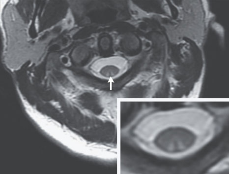 A lesion (which looks like an inverted "V") developed on the man's dorsal column, a part of the spinal cord responsible for feeling physical touch (pictured, the MRI scan and arrow pointing to lesion center)