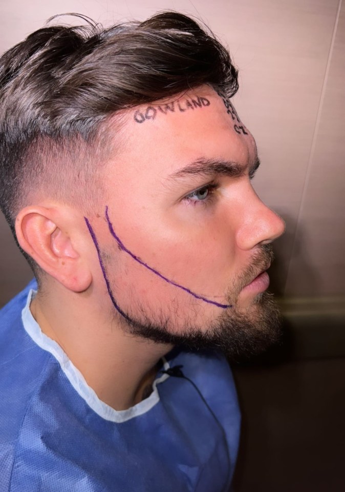 He showed fans the areas on his face where hair has refused to grow