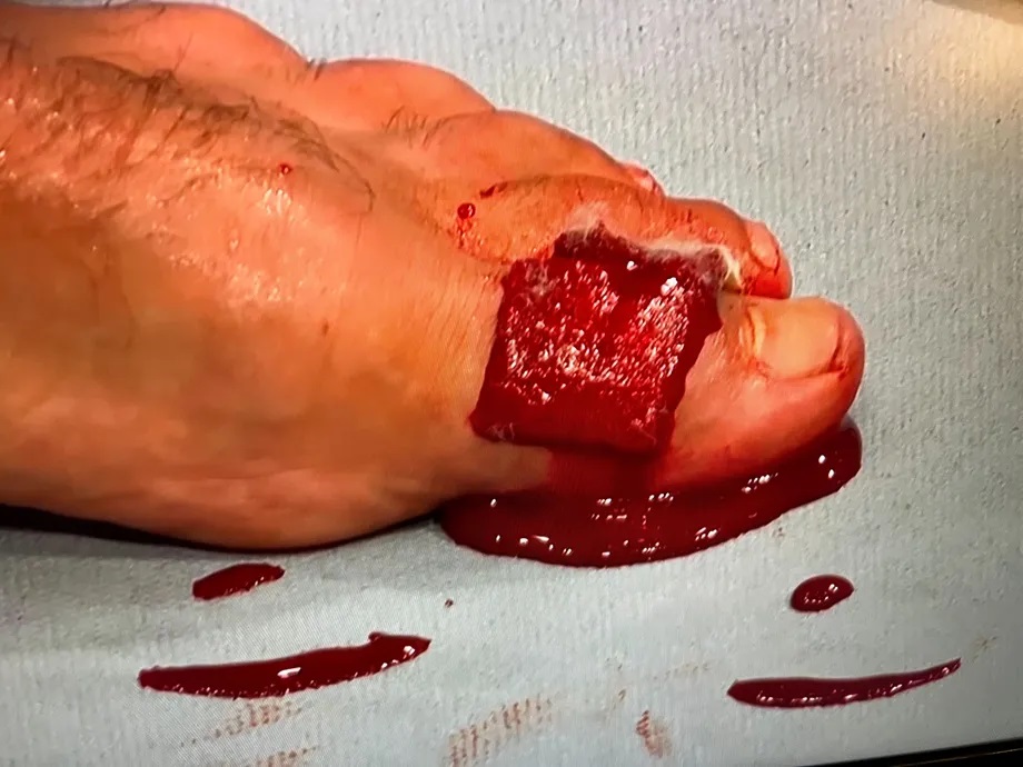 Saint-Denis' left big toe almost split in two