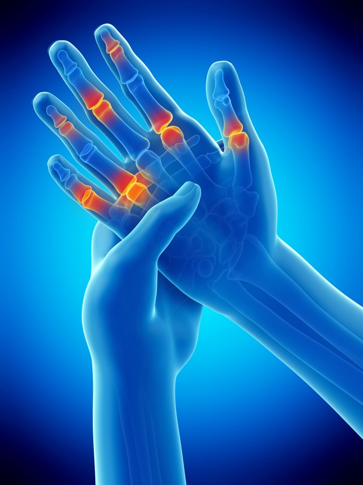 Osteoarthritis affects around nine million people