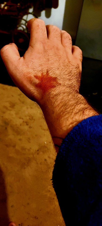 One of the 'starburst-like' burns on Aidan's hand