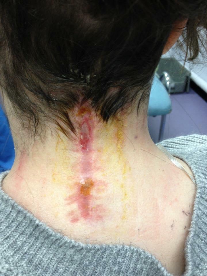 Emily's neck after undergoing spinal surgery