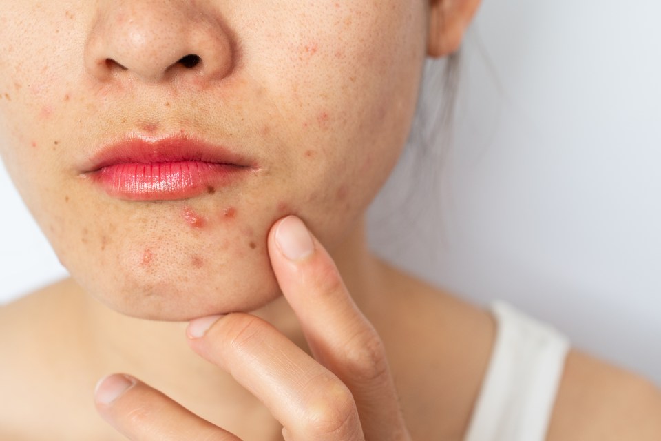 Acne can cause lots of problems for women in the forties