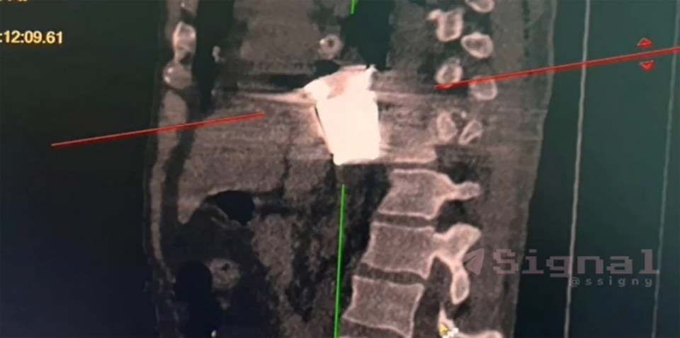 X-rays showed the explosive was lodged between the soldier's ribs and spine