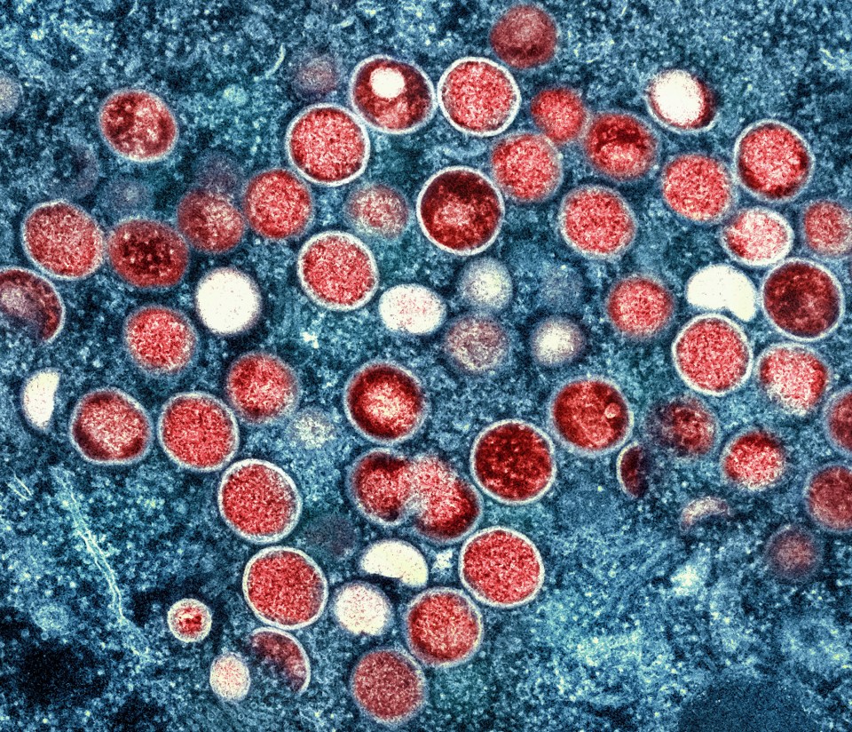 Six cases of mpox have been spotted in Barcelona in July and August