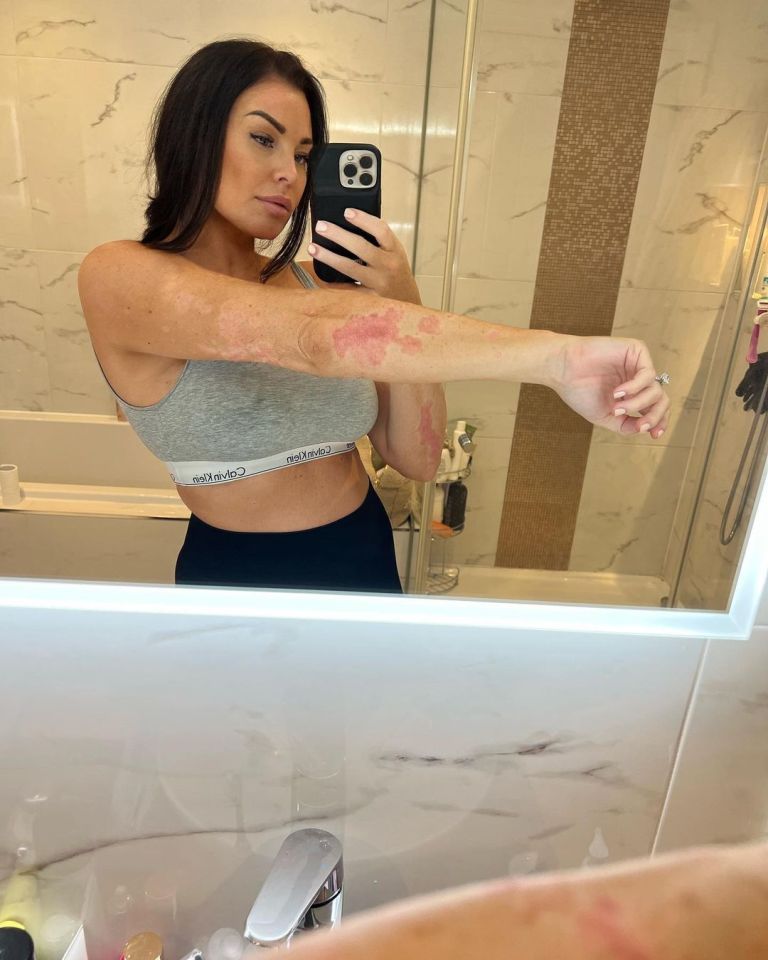 The reality favourite revealed her struggles with psoriasis in October