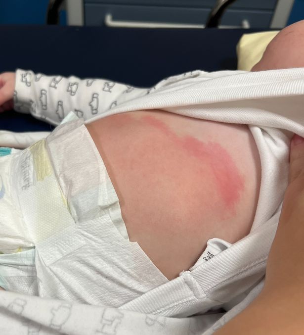 Mum Catie Josey had been putting her little boy to bed when she noticed large red marks on his stomach