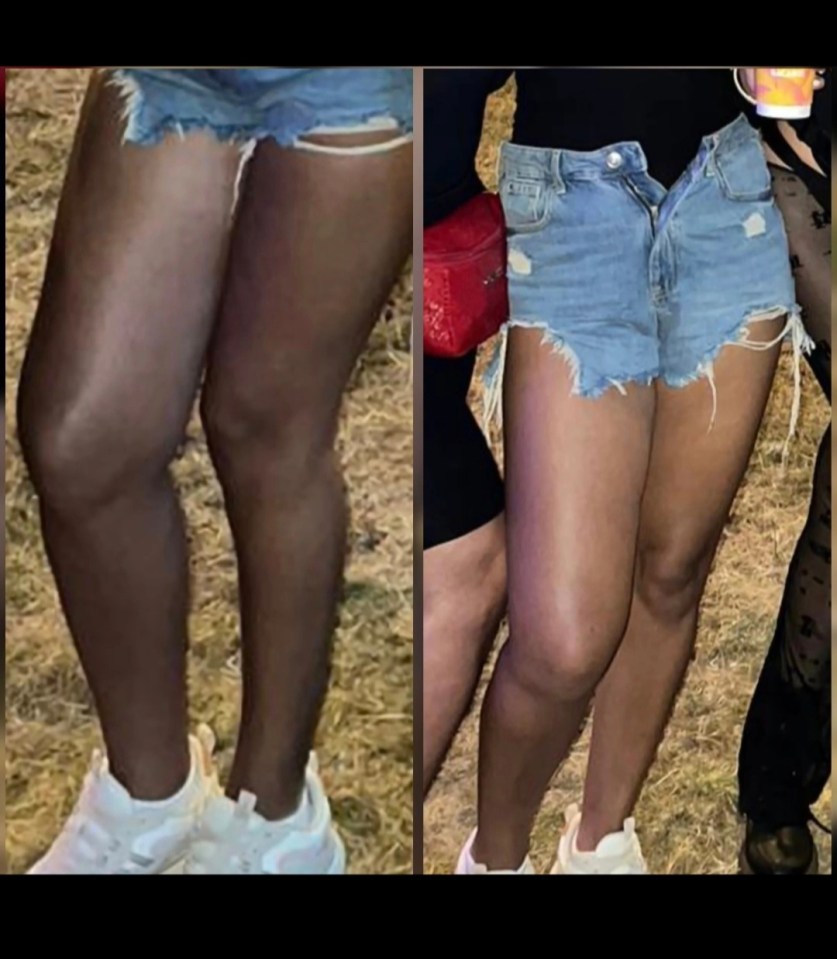 At a festival, Sarah was forced to unbutton her shorts because her right leg became so swollen and painful