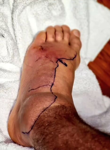 Dustin Poirier showed off his gruesome swollen foot in hospital