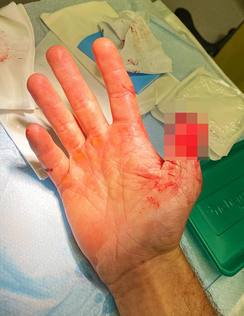 Stephen was told at hospital that his thumb could not be reattached