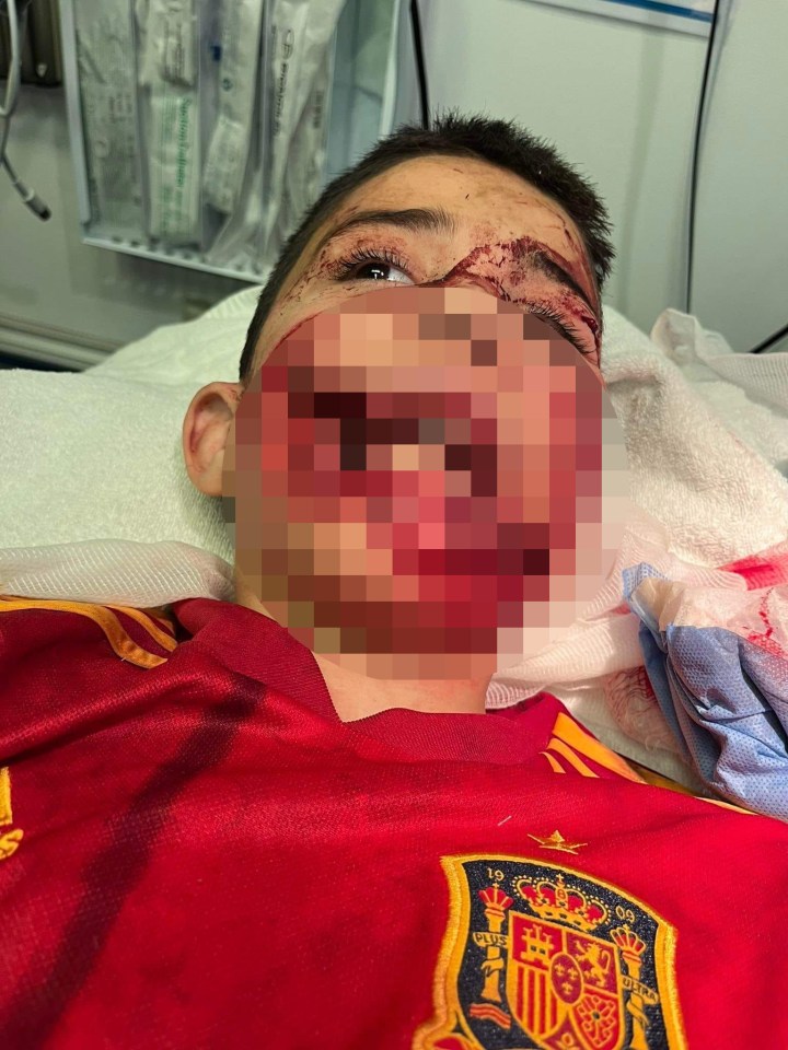 Alejandro Miszan was attacked by a pitbull while playing football near his home