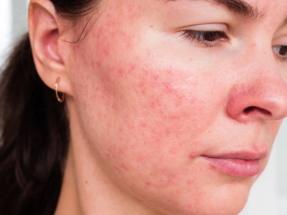 Pictured: a woman with papulopustular rosacea from demodex folliculitis