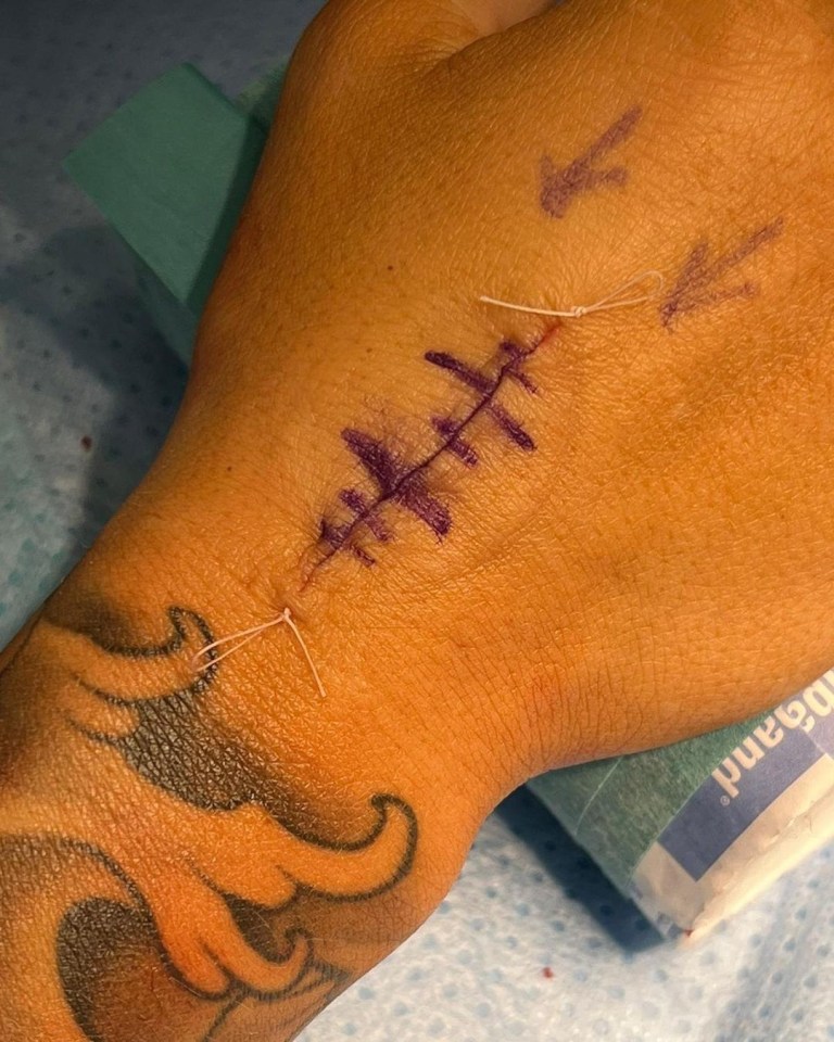 Bridges shares gruesome pictures of her hand surgery