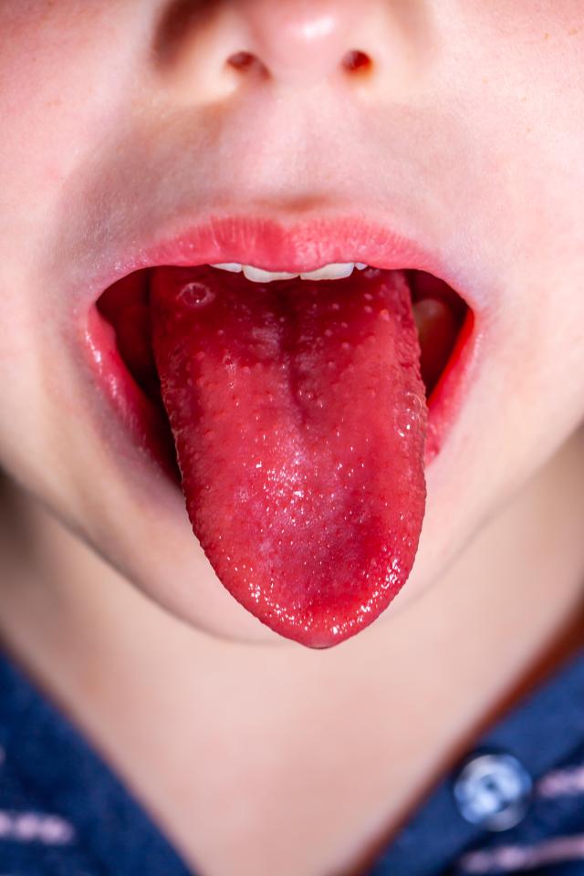 Scarlet fever is another bug to be on the lookout for