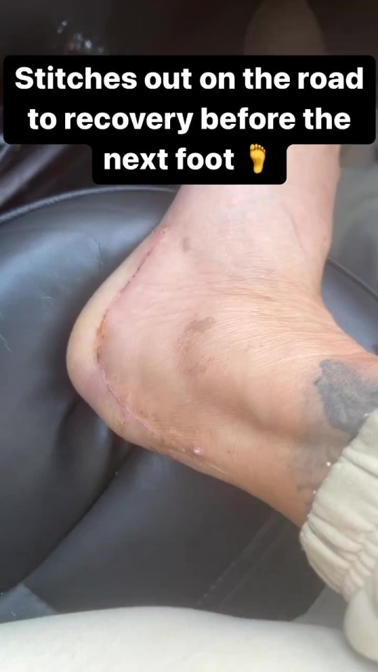 Katie Price has revealed the scar on her foot after her horror accident