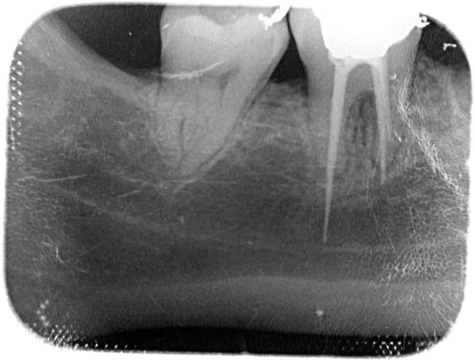 However, she was left with severe nerve damage from the procedure (above), which meant she was unable to feel half her lip or her chin