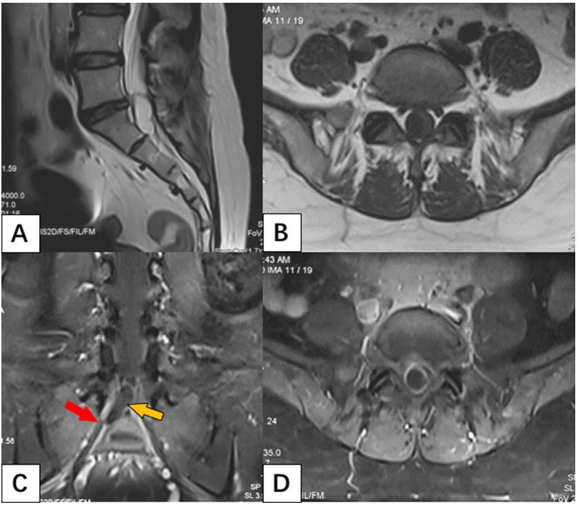 An MRI scan shows the cyst on the spinal cord (yellow arrow)