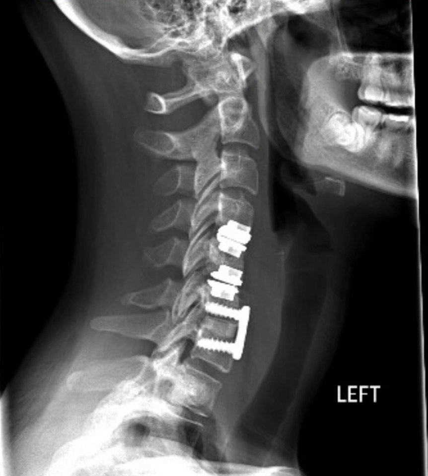 A scan of Abby’s neck with new fused plates and screws with disc replacements