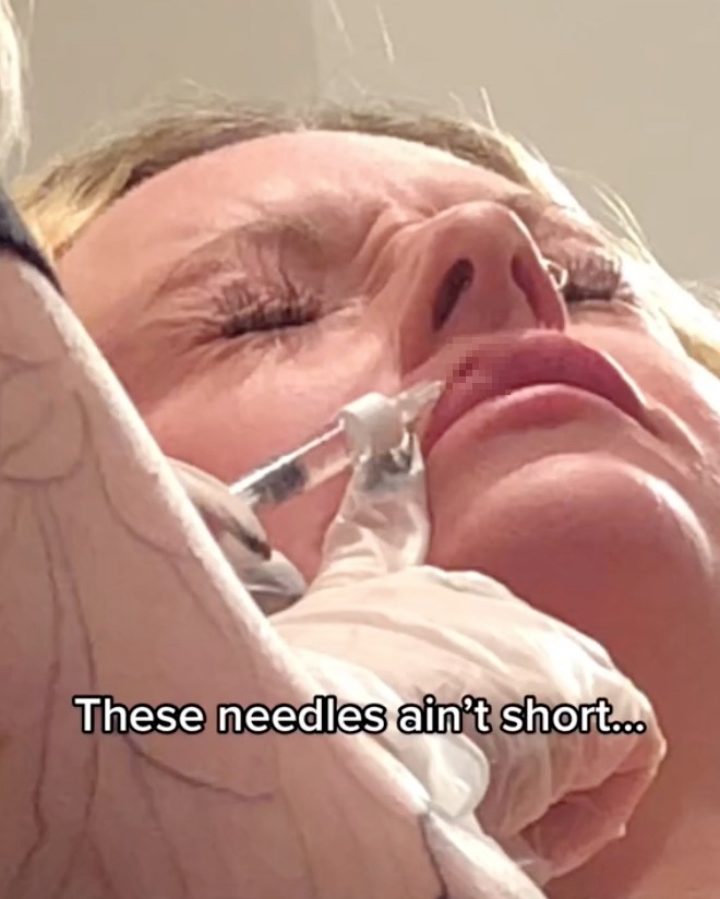 Alex shared clips of herself wincing in pain while getting lip filler