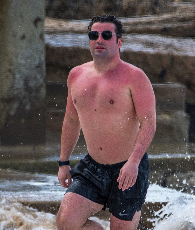 The singer is enjoying a holiday to Barbados and showed off his sunburn