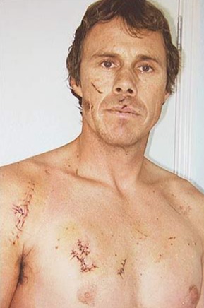 The scars from a great white shark’s jaw can be seen outlined on Eric Nerhus’ chest