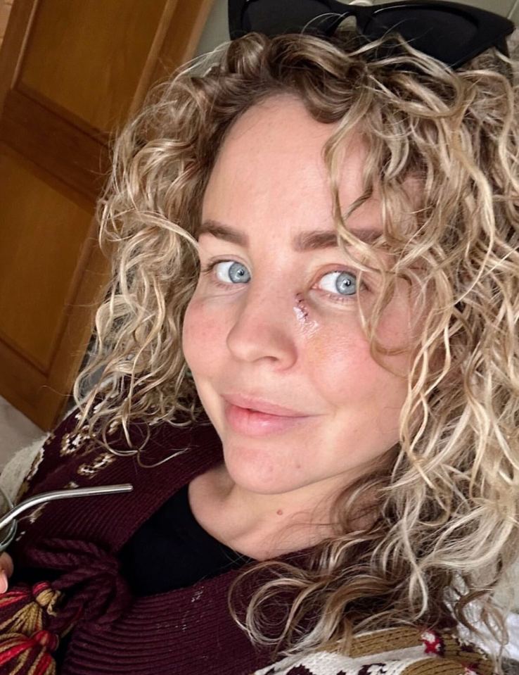 Lydia Bright revealed she had a lump removed under her eye