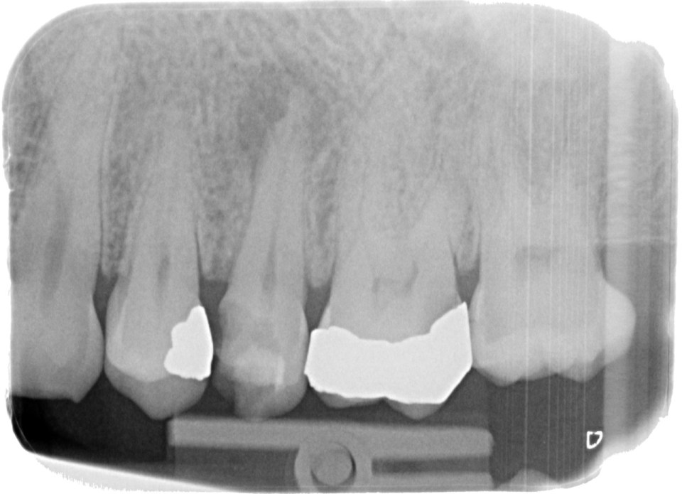 The image above shows untreated decay and infection