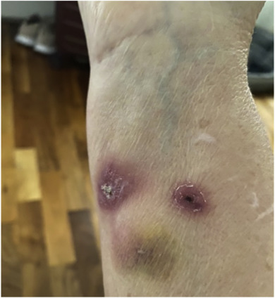 Wounds on the forearm the 64-year-old infected with the bug (pictured)