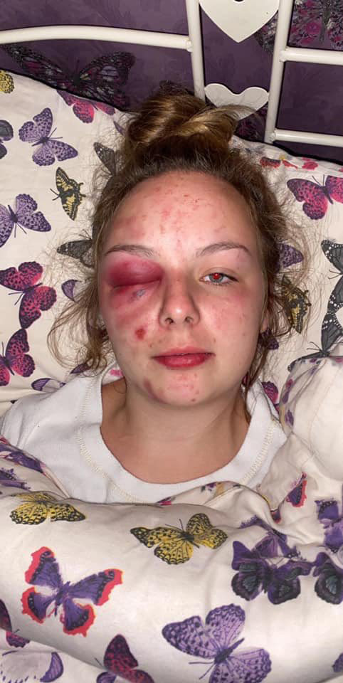 Eleanor Williams, 22, falsely claimed four men raped, attacked and even trafficked her for sex - here is one of the photos she shared of her 'injuries' online