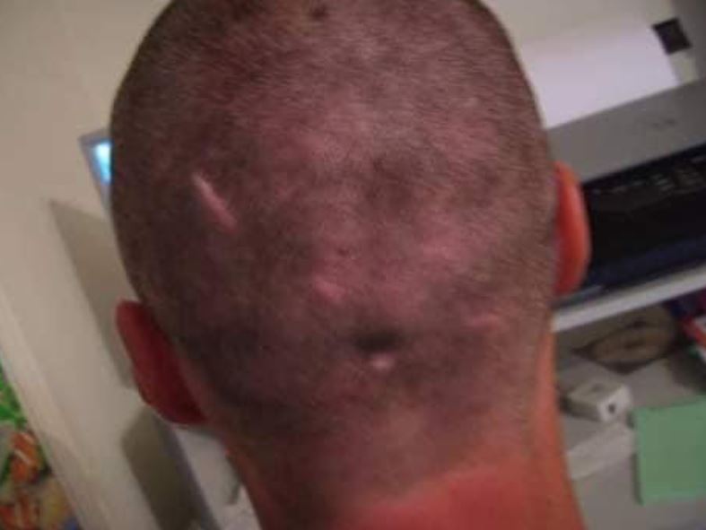 Scars from when the shark clamped its jaws on Eric’s head for the final time