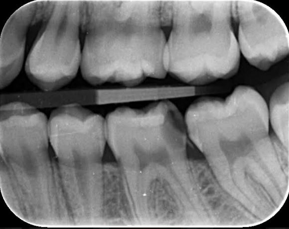 The image above shows the large area of decay in Hannah's mouth