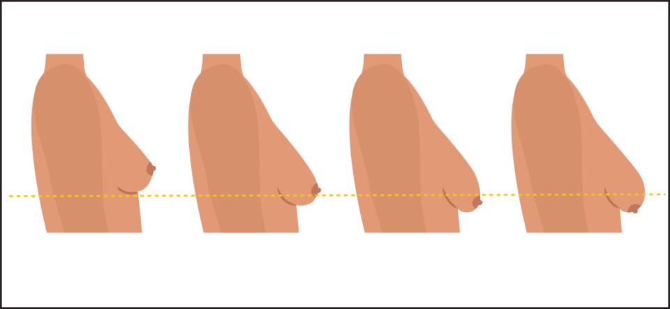 A chart showing the grades of breast sagging