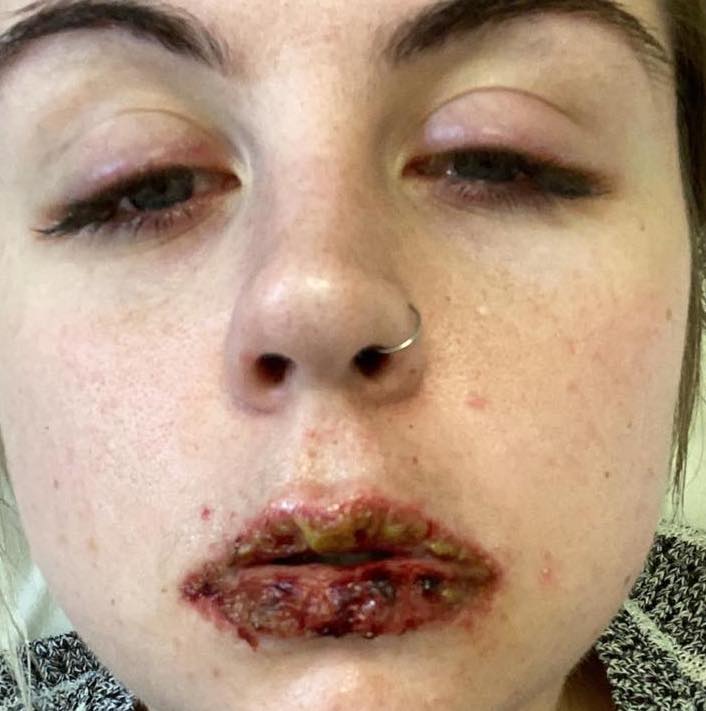 Not long after, the 26-year-old was left with sores all over her lips and a rash on her body which she said made her feel like her body was burning from the inside out