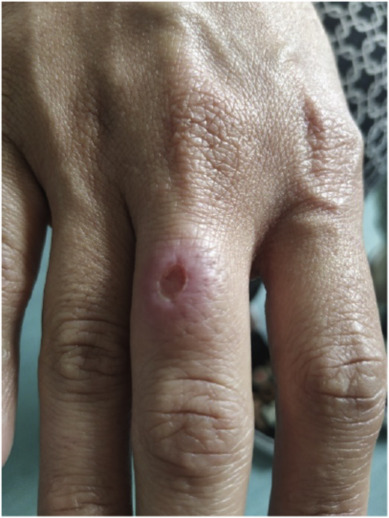 The hand of a 30-year-old woman with an infected ulcer (pictured)