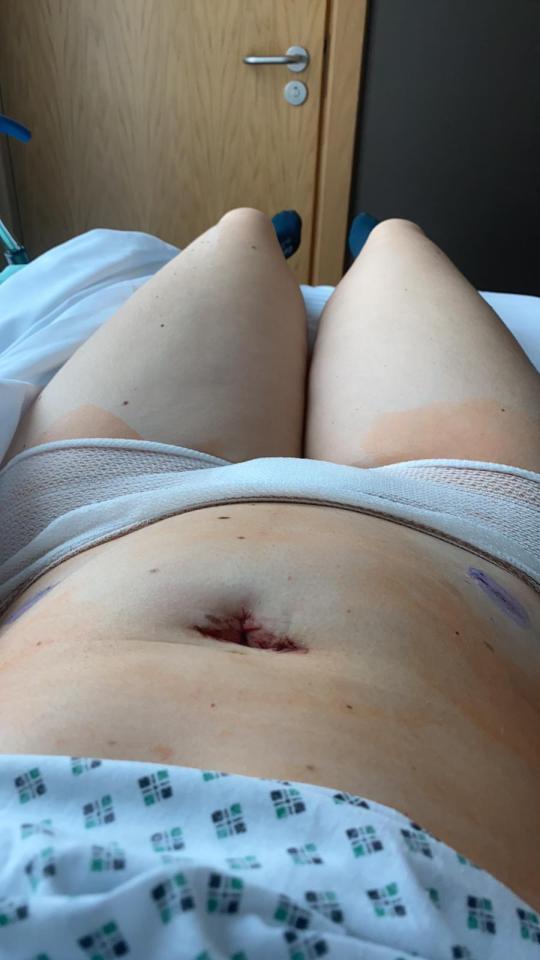 At university, Sally's symptoms worsened - she had bladder and bowel problems on top of her pain and everything pointed towards her having endometriosis