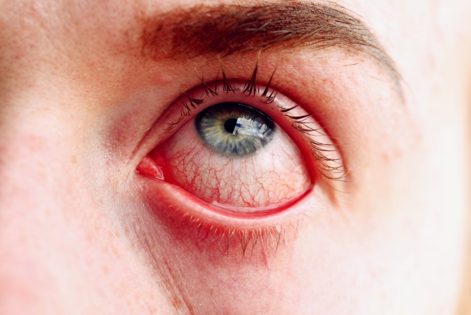 The  'Arcturus' Covid variant could be giving people pinkeye, making it even harder to tell apart from hay fever and other viruses