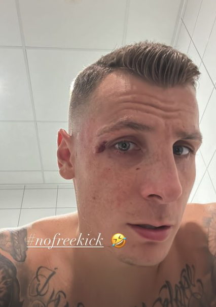 Digne took to Instagram after the game showing off the cut