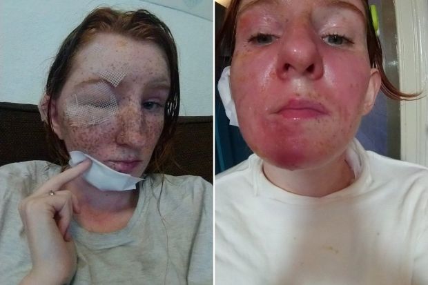 Charlotte Foster suffered first and second degree burns in the attack