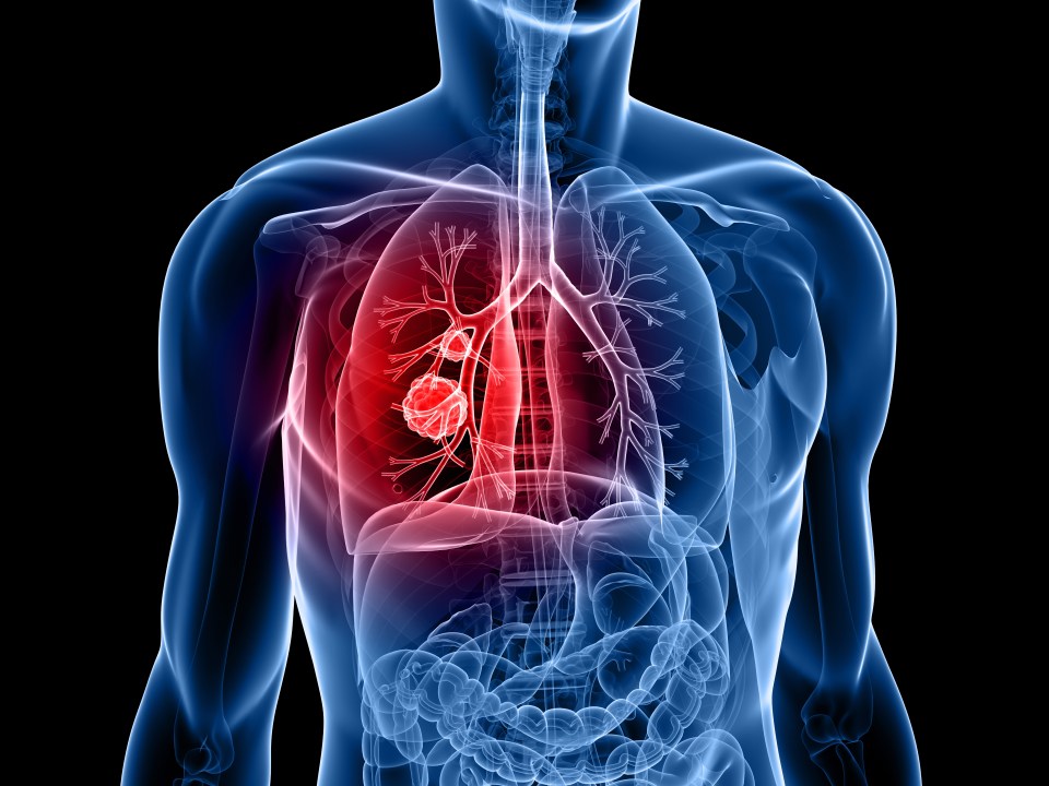 Night sweats can be a sign of lung cancer you notice as soon as you wake up, experts say