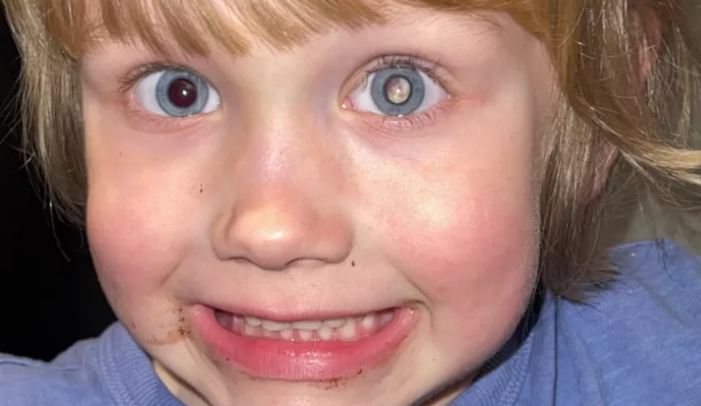 The three-year-old has a rare type of eye cancer known as Retinoblastoma